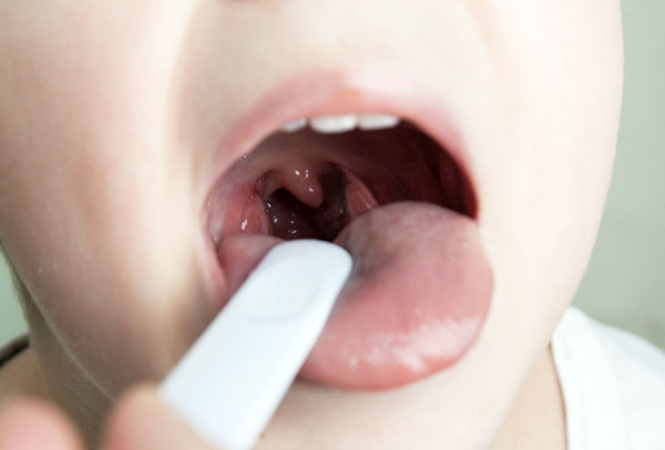 Penyebab Tonsil Stone